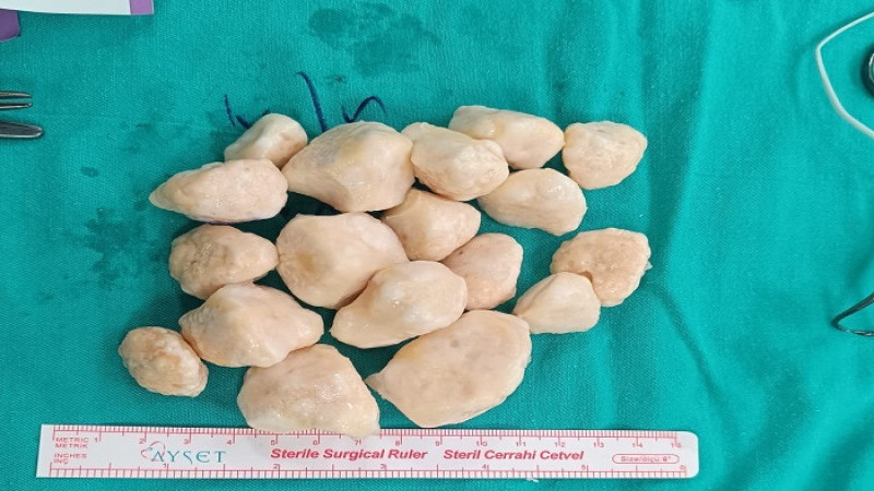 Malatya'da 73 Yaşındaki Kadının Dizinden 24 Taşlaşmış Tümör Çıktı